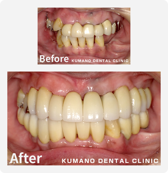 咬合崩壊の症例01 春日井市の歯科医院 くまの歯科