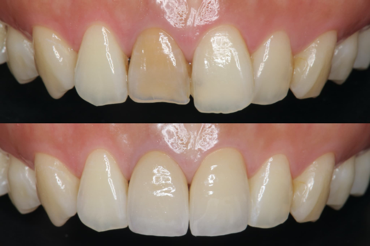 歯の被せ物によって前歯を美しく整えた前後のイメージ