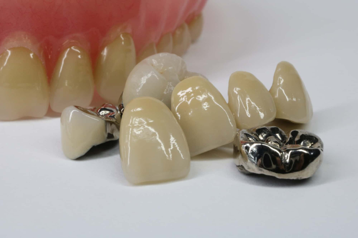 色々な種類の歯の被せ物のイメージ