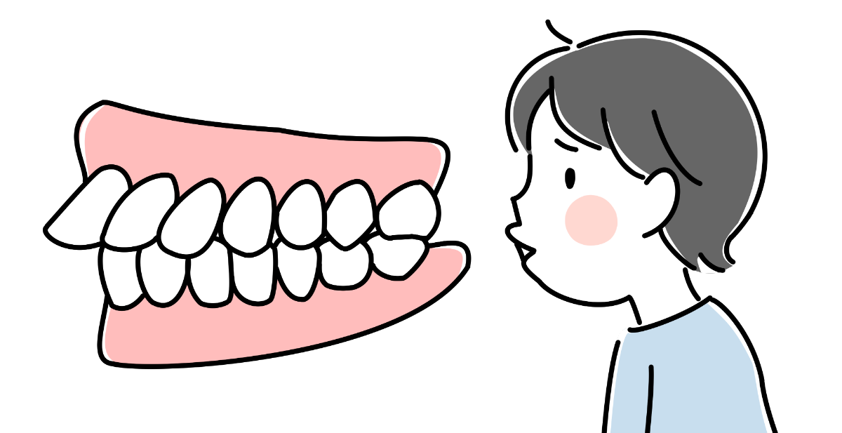 矯正治療が推奨される子どもの出っ歯
